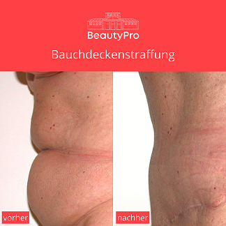 Baudeckenstraffung Beauty OP Klinik am Wittenbergplatz