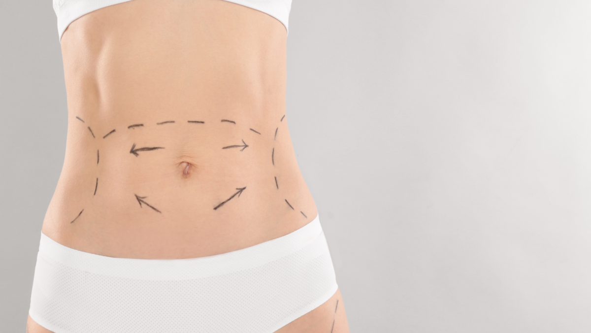 Fettabsaugung und Bauchdeckenstraffung: Ein Blick auf zwei häufig nachgefragte Maßnahmen in der plastischen Chirurgie